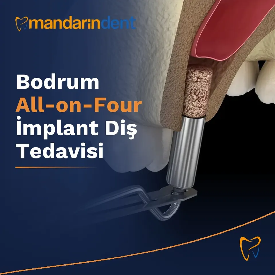 Bodrum All-on-Four İmplant Diş Tedavisi