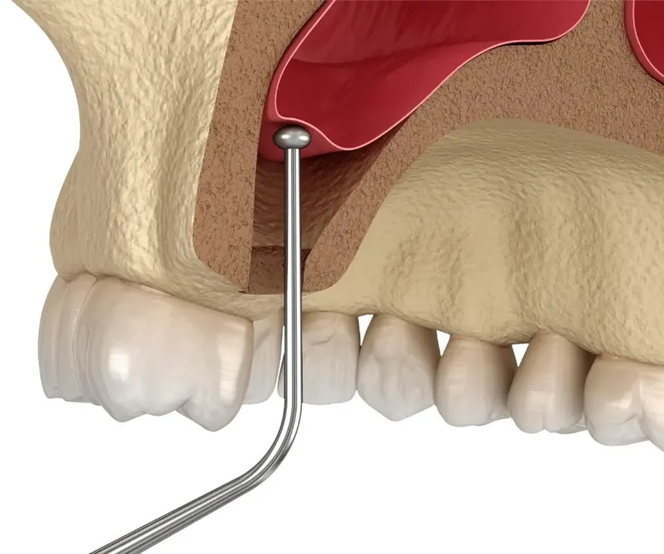 Bodrum kemik grefti ve sinüs kaldırma ile çene kemiğinizi güçlendirin, implant tedavinizi mümkün kılın. Güvenli tedavi için Mandarin Dent yanınızda!