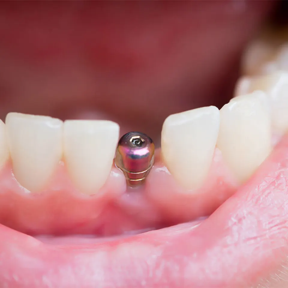 bodrum tek diş implant