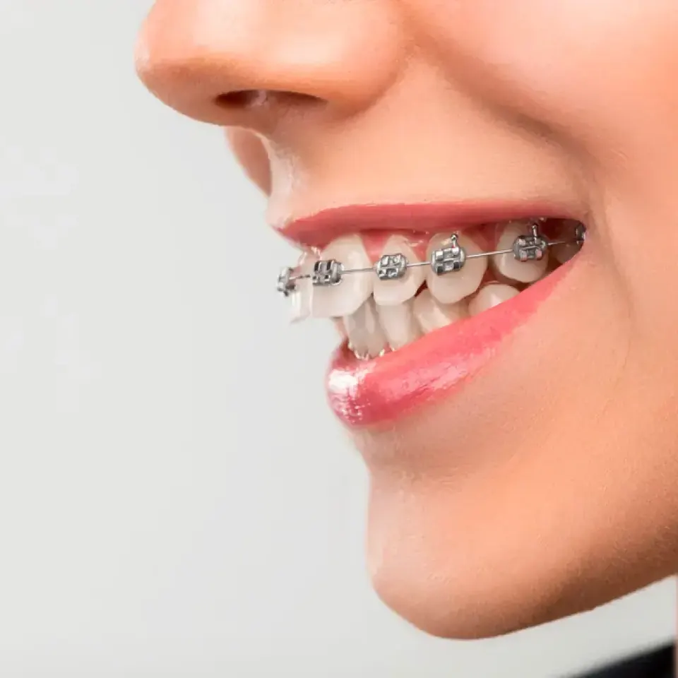 Bodrum Metal Diş Telleri