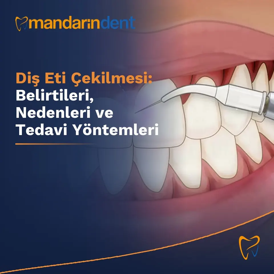 Diş Eti Çekilmesi: Belirtileri, Nedenleri ve Tedavi Yöntemleri