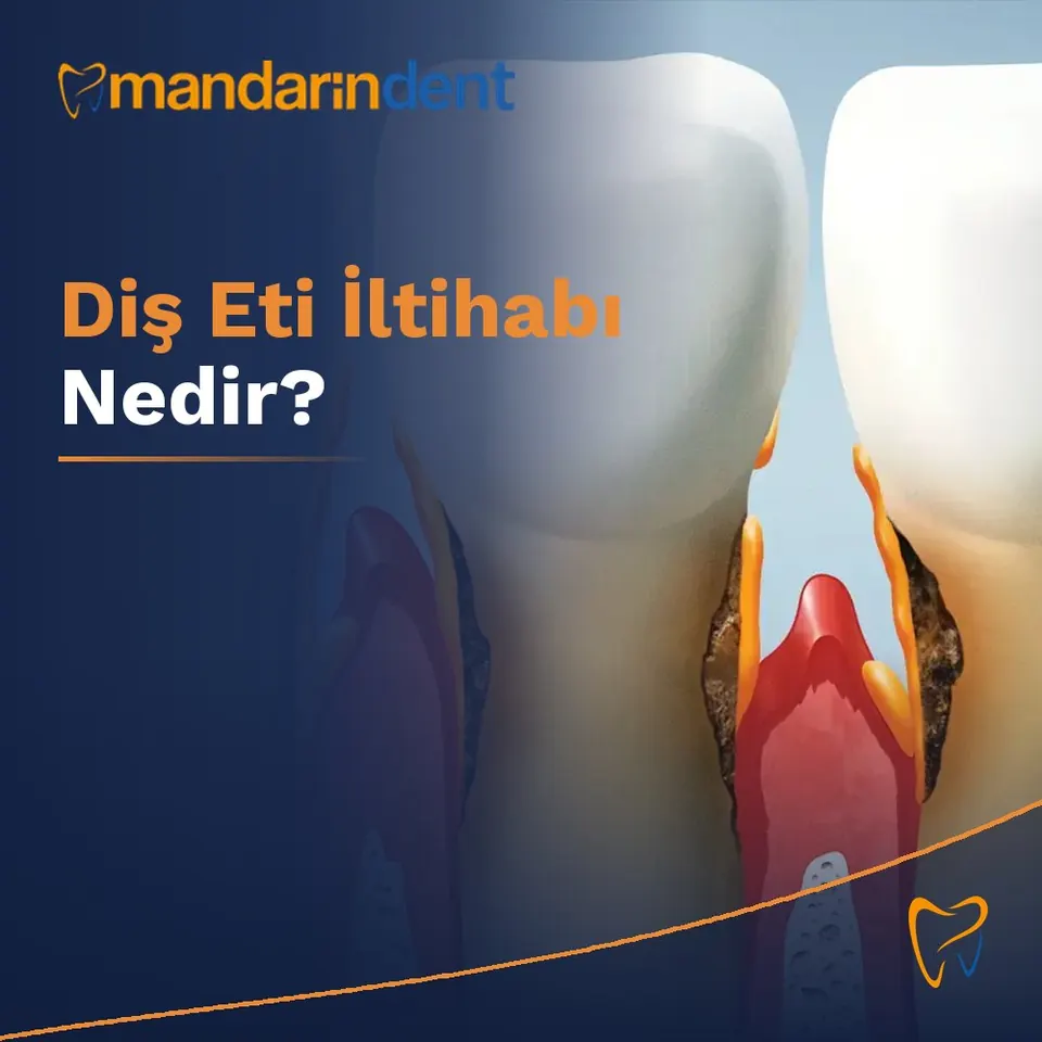 Diş Eti İltihabı Nedir?