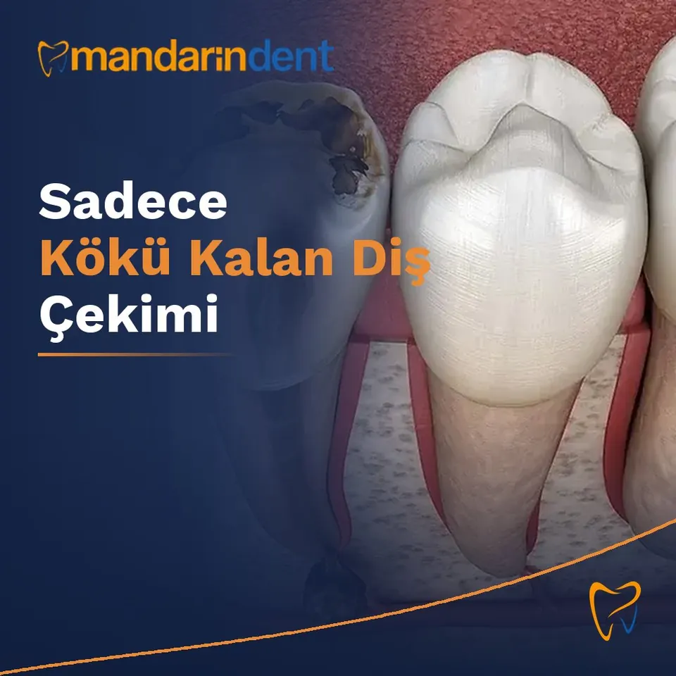 Sadece Kökü Kalan Diş Çekimi
