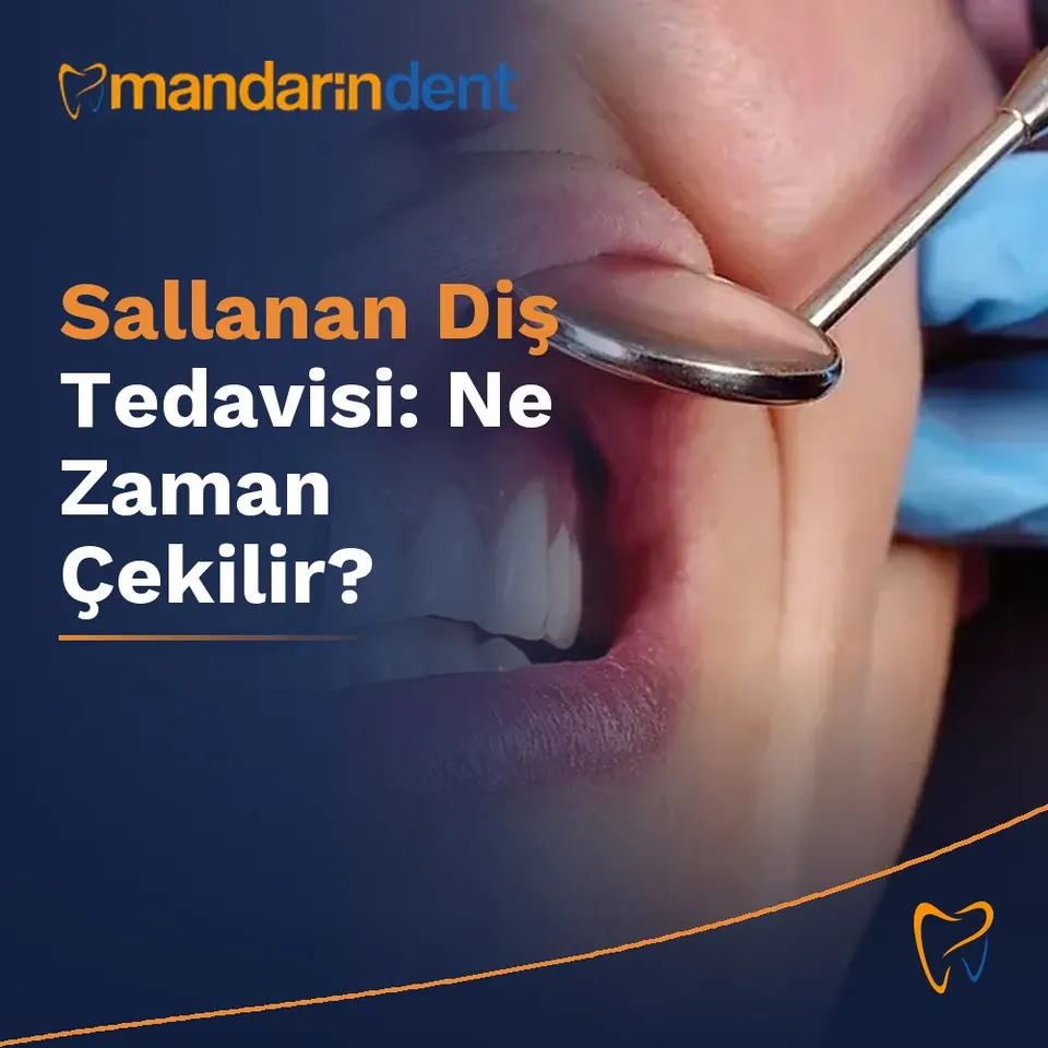 Sallanan Diş Tedavisi: Ne Zaman Çekilir?