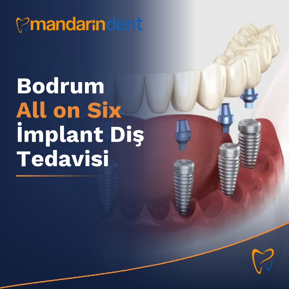 Bodrum All on Six İmplant Diş Tedavisi