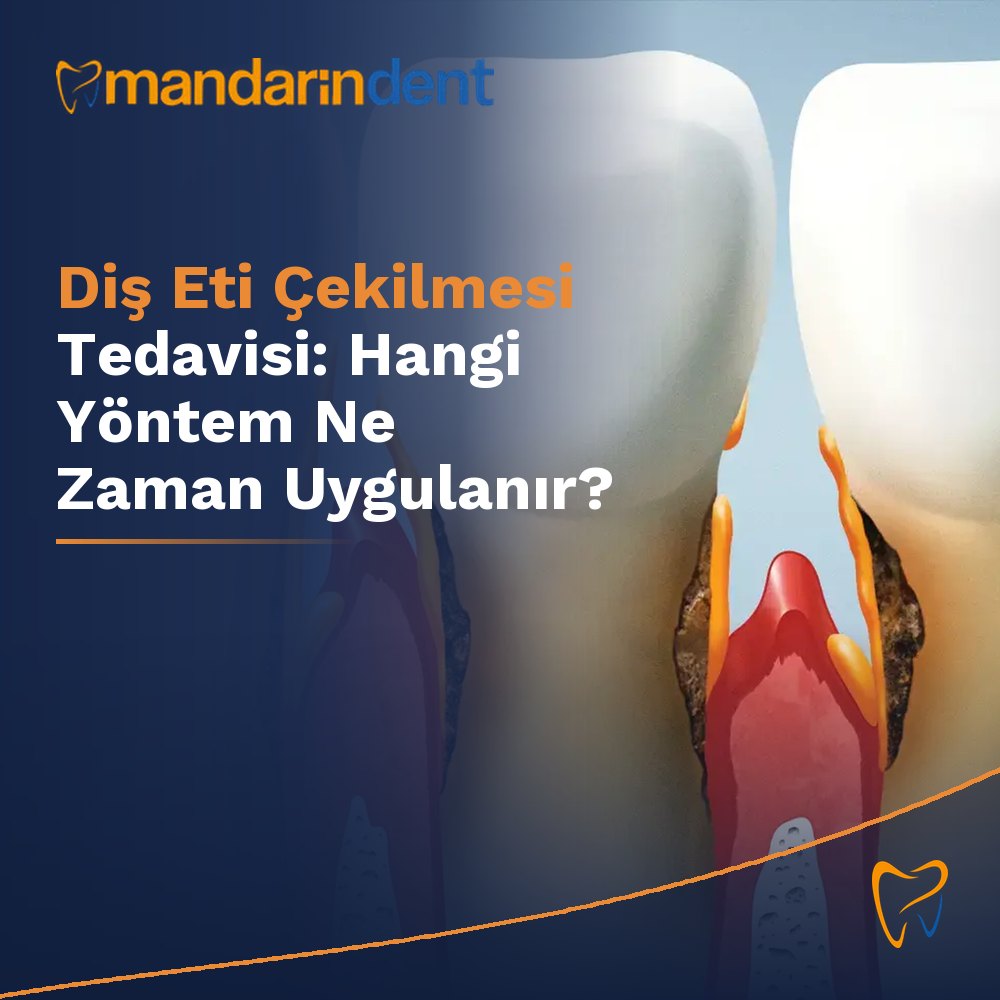 Diş Eti Çekilmesi Tedavisi: Hangi Yöntem Ne Zaman Uygulanır?