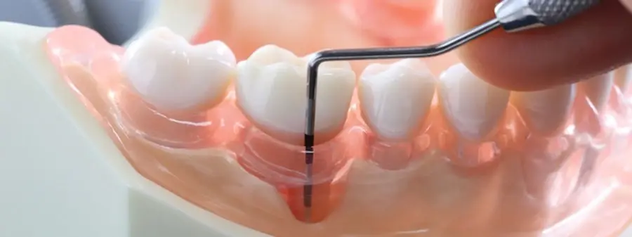 Bodrum Periodontal Küretaj ve Cerrahi