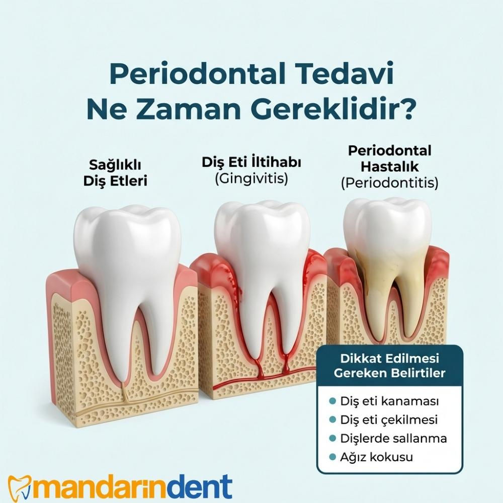 Periodontal tedavisi nasıl yapılır?