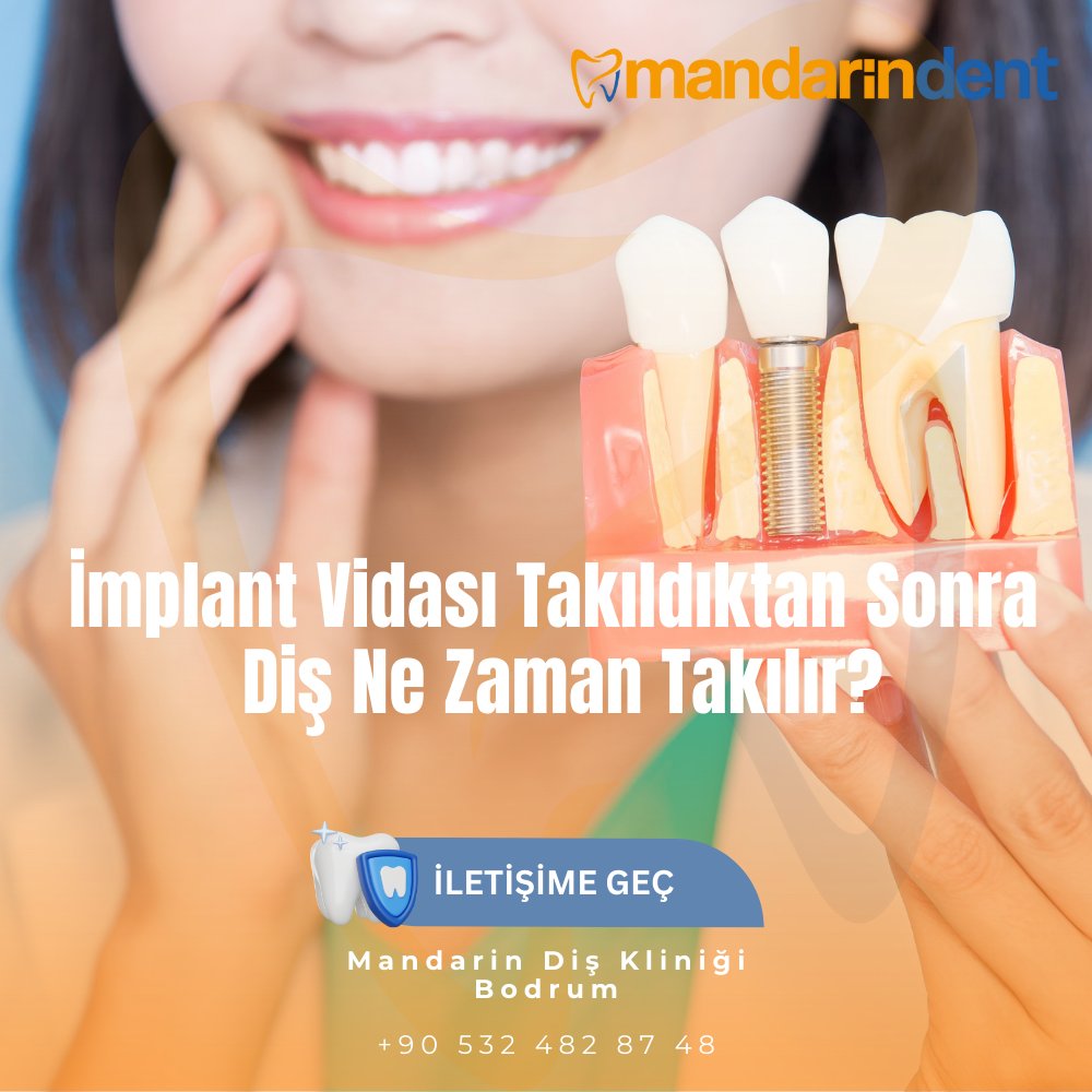 komple diş yaptırmak ne kadar sürer