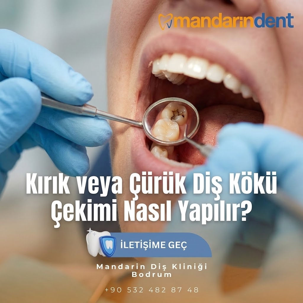Kırık veya Çürük Diş Kökü Çekimi Nasıl Yapılır?