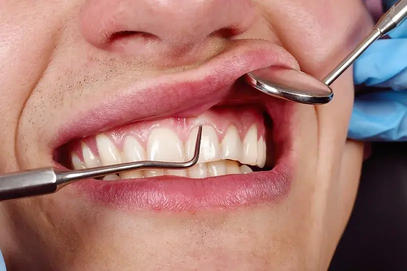 bodrum Periodontal Küretaj
