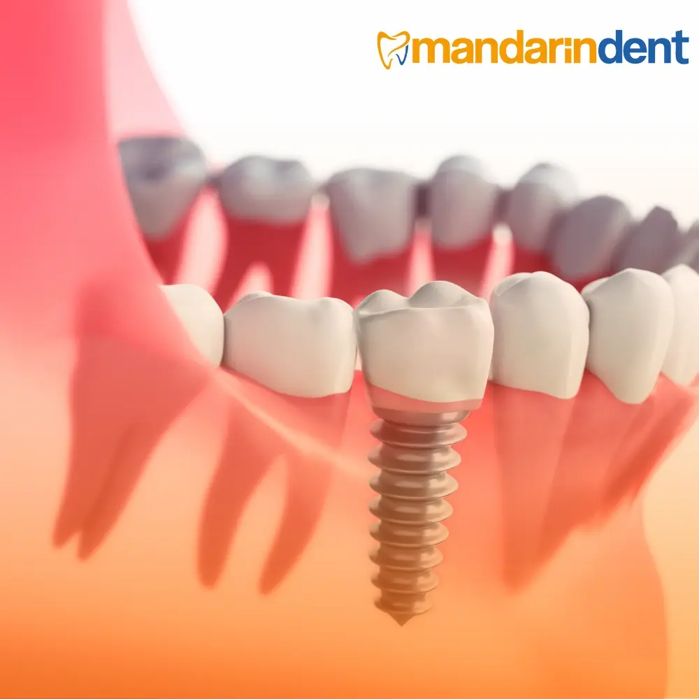 Bodrum All on four İmplant Tedavisi, Bodrum En İyi Diş İmplant Kliniği, Bodrum 
all on 4 dental implants