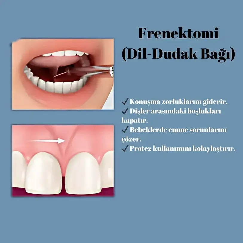 bodrum Frenektomi