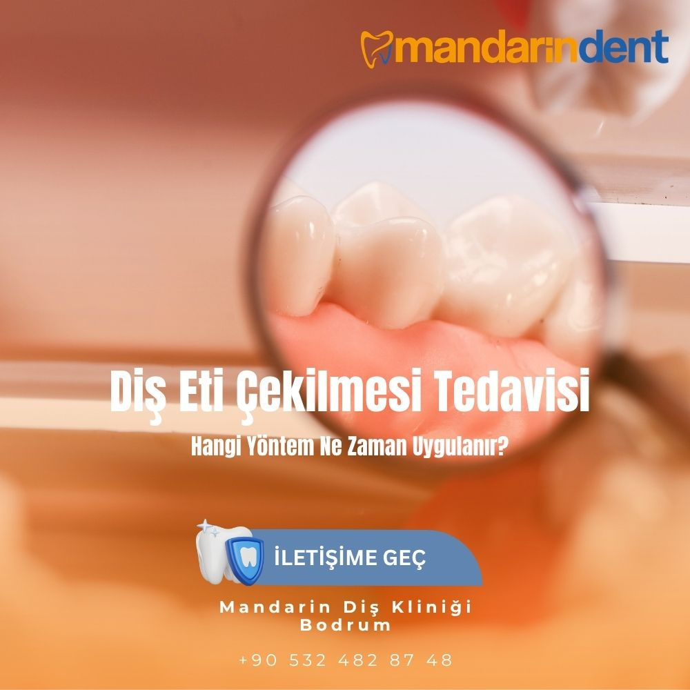 Diş Eti Çekilmesi Tedavisi: Hangi Yöntem Ne Zaman Uygulanır?