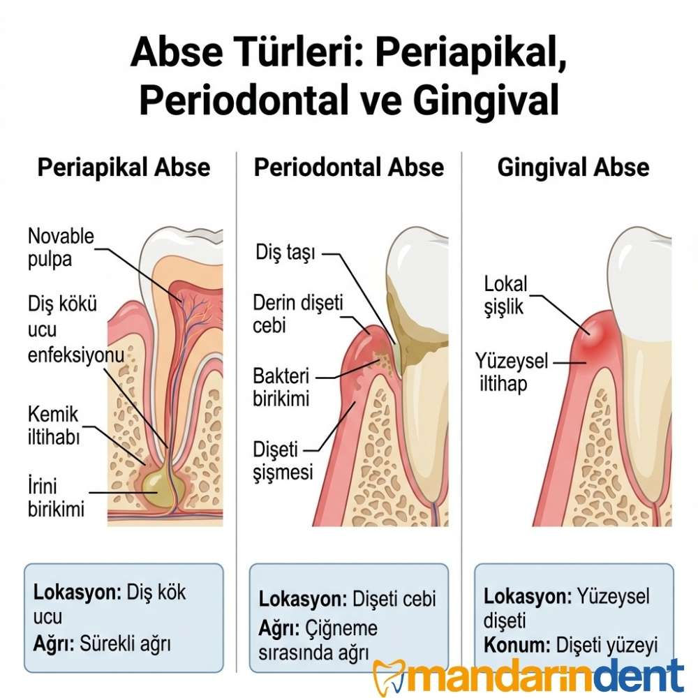periapikal periodontal ve gingival apse farkları