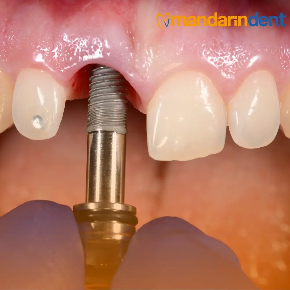 Borum All on four Dental İmplant Tedavisi, Bodrum En İyi Diş İmplant Kliniği,  Bodrum 
all on 4 dental implants