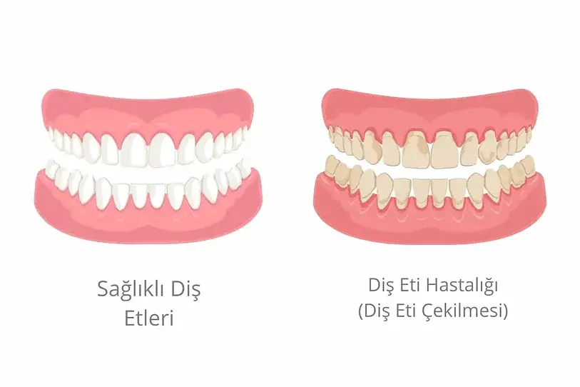 bodrum Diş Eti Çekilmesi