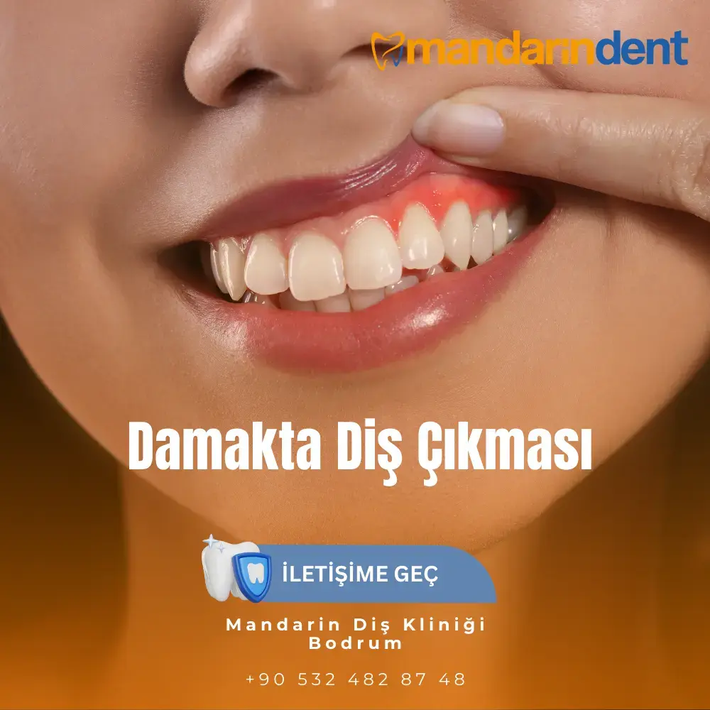 Damakta Diş Çıkması