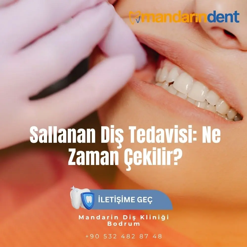 Sallanan Diş Tedavisi: Ne Zaman Çekilir?