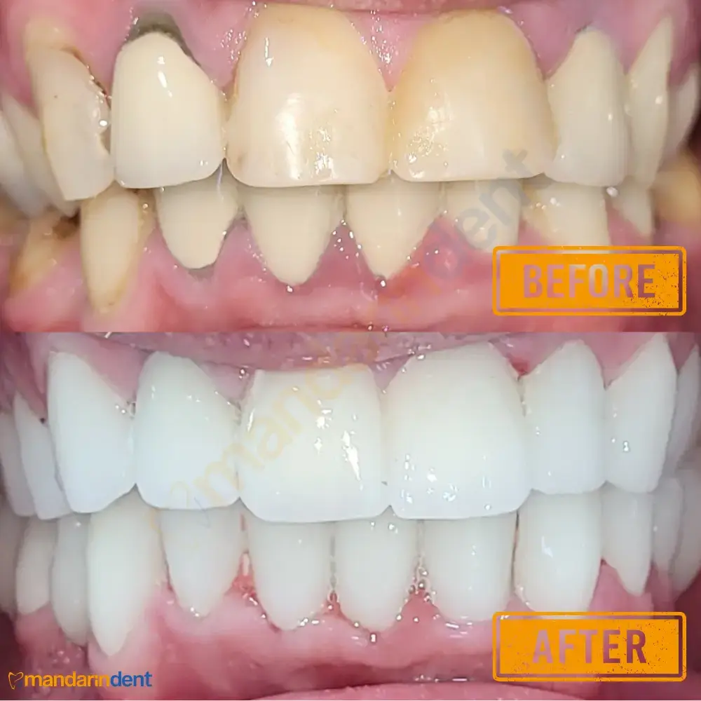 Zirconium crowns at MandarinDent Bodrum — the before photo above, the result below