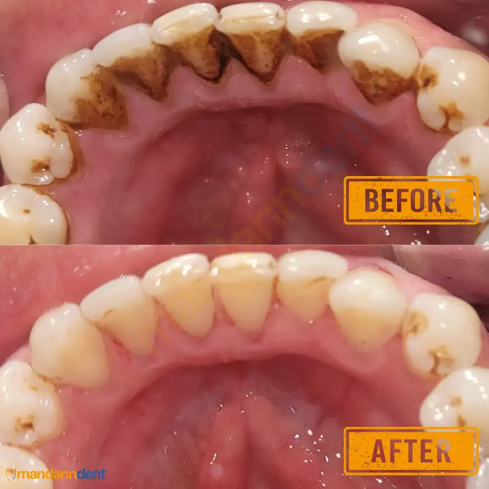 Scaling & polishing at MandarinDent Bodrum — the before photo above, the result below