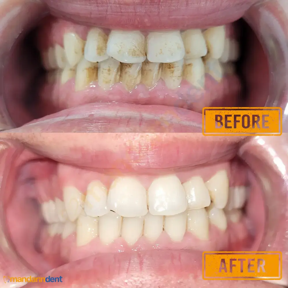 Scaling & polishing at MandarinDent Bodrum — the before photo above, the result below