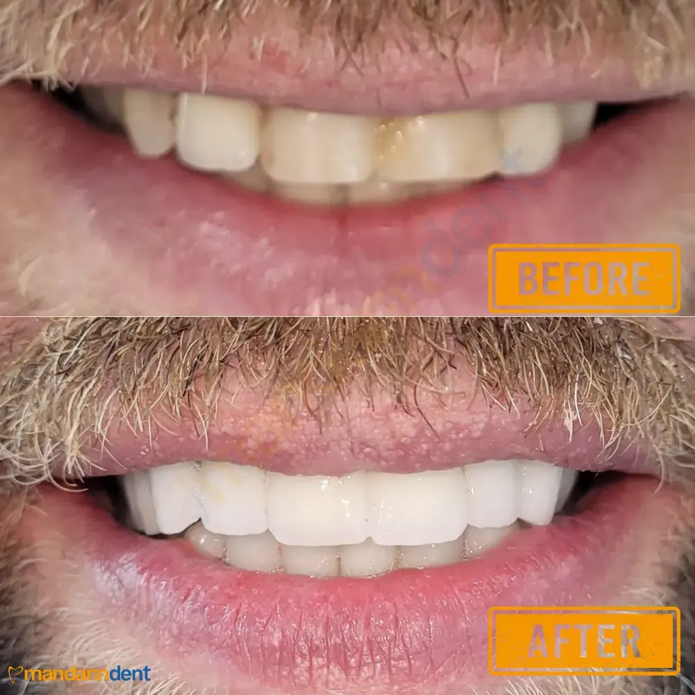 Smile design at MandarinDent Bodrum — the before photo above, the result below