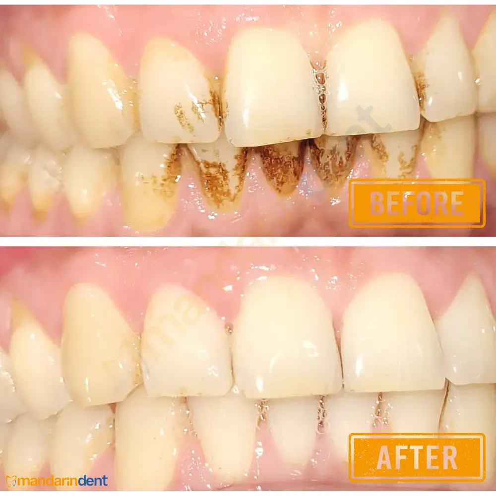 Scaling & polishing at MandarinDent Bodrum — the before photo above, the result below