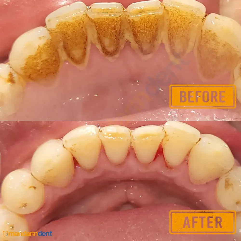 Scaling & polishing at MandarinDent Bodrum — the before photo above, the result below