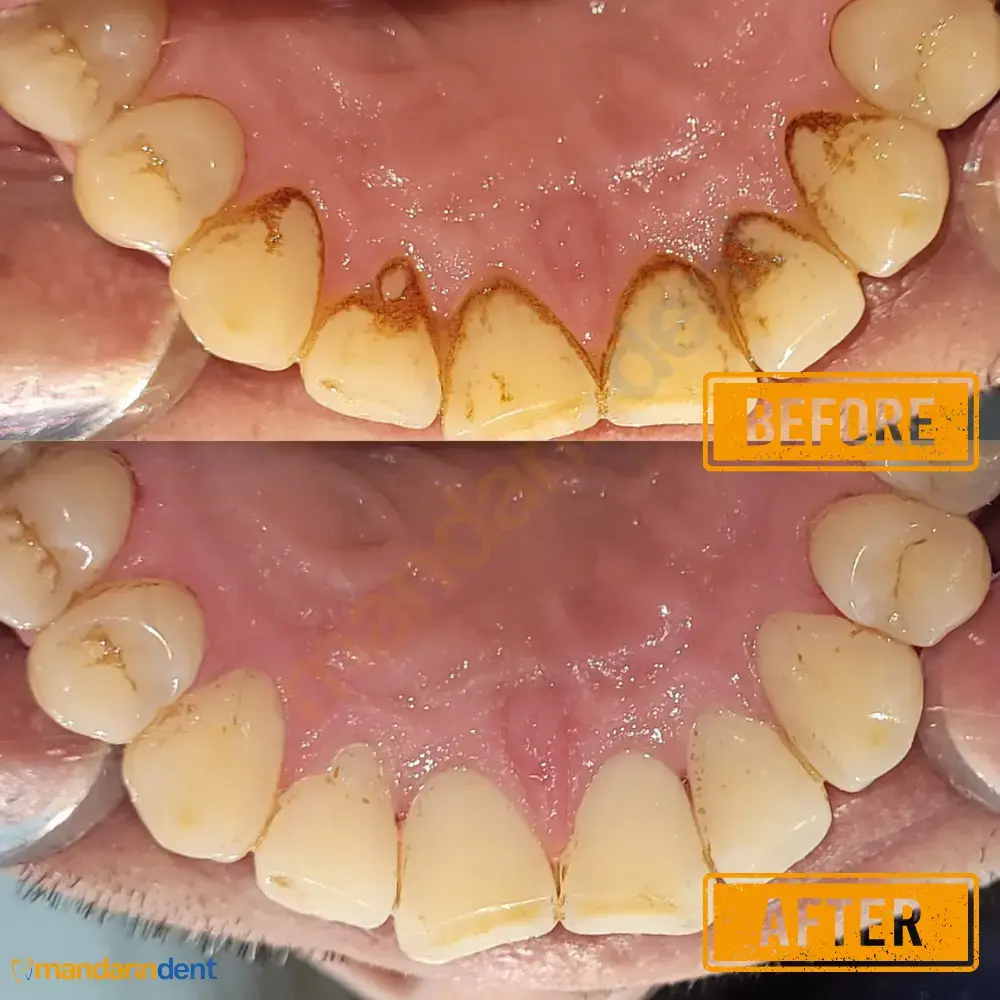Scaling & polishing at MandarinDent Bodrum — the before photo above, the result below