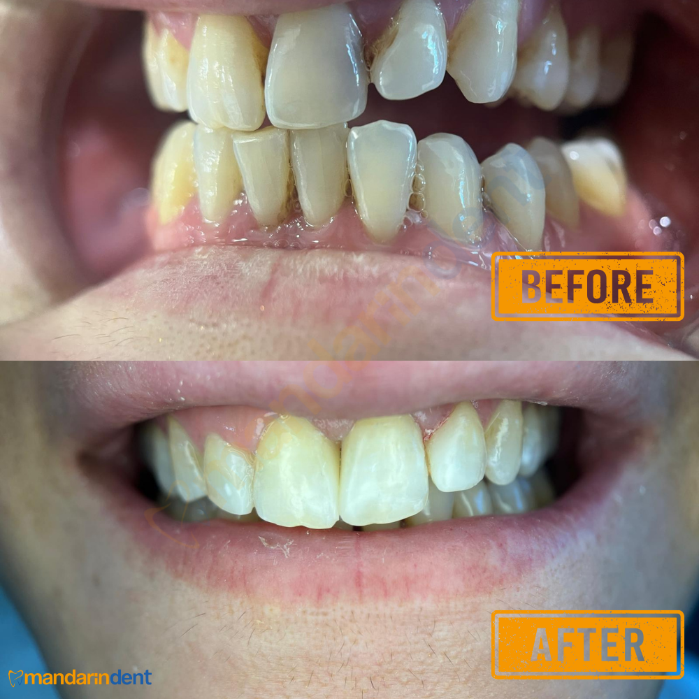 Composite bonding at MandarinDent Bodrum — the before photo above, the result below